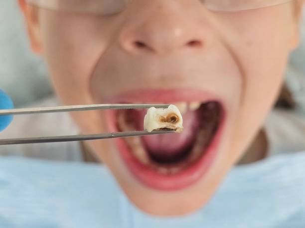 Best Emergency Treatment for Toothache in Fannett, TX