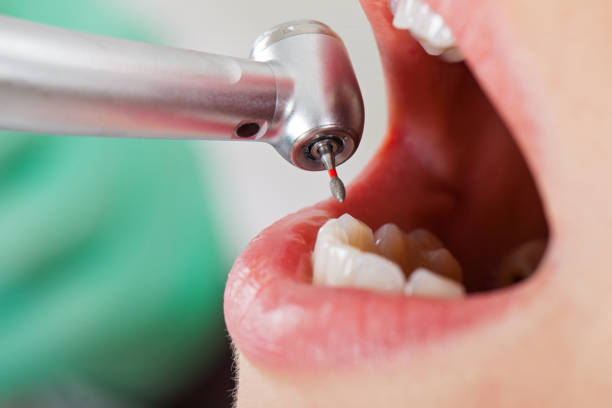 Best Emergency Tooth Extraction in Fannett, TX